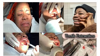 4 Teeth 🦷 Extracted For Braces  premolar Extractions Pt1 [upl. by Ahseirej734]