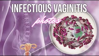 Infectious Vaginitis Photos  CRASH Medical Review Series [upl. by Kensell678]