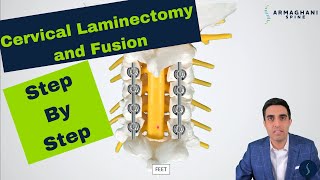 Posterior Cervical Laminectomy and Fusion  Procedure details recovery and expectations [upl. by Roberts7]