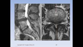 Lumbar Spinal Stenosis Cauda Equina Syndrome Sciatica amp Disc Herniation An Advanced Lecture [upl. by Nahtnamas849]