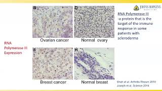 Scleroderma and Cancer What are the Connections Laura K Hummers MD ScM [upl. by Noemi]