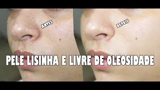 LIMPEZA DE PELE CASEIRA PARA PELE OLEOSA OU COM ACNE [upl. by Conrado788]