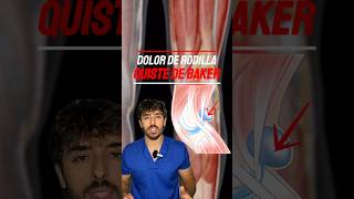 ❗️¿QUÉ ES EL QUISTE DE BAKER❗️popliteo rodilla dolor fisio doctor anatomia sabiasque [upl. by Nnaear]