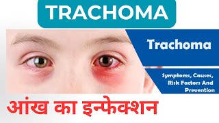 Trachoma रोहे आंख का इन्फेक्शन । कैसे फैलता है और क्यों [upl. by Binette]