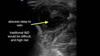 Abscess Deep to Superficial Phlebitis [upl. by Yl]