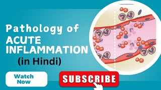 Acute inflammation explained in Hindi acuteinflammation inflammation pathology [upl. by Ahsan]