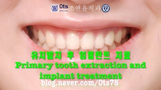 유치발치 후 임플란트치료 Primary tooth extraction and implant treatment [upl. by Ping497]