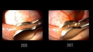 Meibomian gland dysfunction progression over 1 year [upl. by Shiller340]