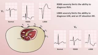 Intro to EKG Interpretation  Bundle Branch Blocks [upl. by Nuawed]