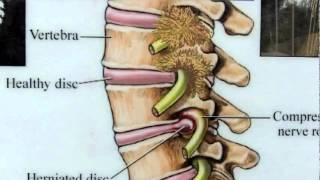 8  Entrapment in Spine [upl. by Ing]