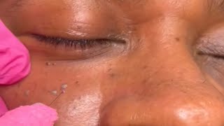 DPN Dermatosis Papulosa Nigra Removal [upl. by Teillo720]