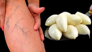 Leg pain rheumatism varicose veins arthritis headache joint pain [upl. by Lemyt942]