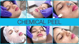 Chemical Peel  Chemical Peel for Acne  Chemical peel Before After Zolie Skin clinic [upl. by Chabot]