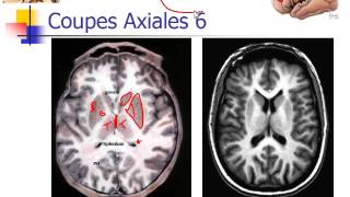 Dr Hasboun Coupes axiales [upl. by Aneel647]