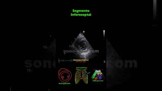 Ecocardiografía  Hipocinesia Inferolateral E Inferior [upl. by Lodge]