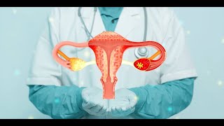 Rectosigmoid Endometriosis A Rare Cause of Haemafacia [upl. by Aicela]