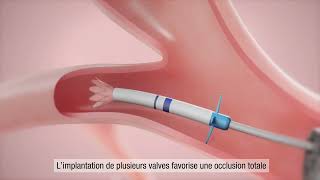 La valve endobronchique Zephyr® pour les personnes atteintes de BPCO et demphysème Français [upl. by Harimas]