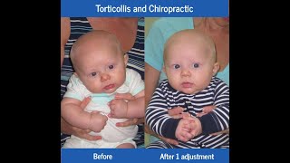 Torticollis and Chiropractic [upl. by Spatz]