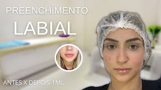 Preenchimento labial antes e depois 1 ML de Ácido Hialurônico [upl. by Aikcin554]