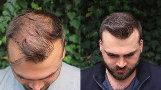 Hair Transplant Result with 3040 Grafts  EXTREME TRANSFORMATION from 0 days to 10 Months [upl. by Tegdirb54]