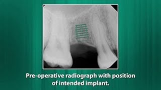 TwoStage Implant Placement for a Congenitally Missing Maxillary Premolar [upl. by Yelrihs127]