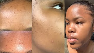 This Dermatologically Approved Routine Cleared My Skin 🥺 [upl. by Marybeth]