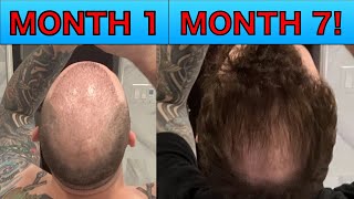 FUE Hair Transplant month 7 Update Second FUE hair transplant [upl. by Brosy511]