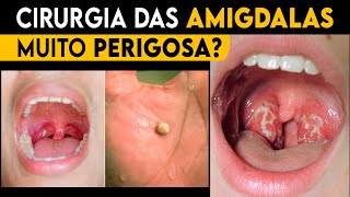 Cirurgia das Amígdalas Ela é BOA ou é PERIGOSA Resolve os Cáseos [upl. by Ylrae]