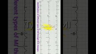 Types of MI  ECG 🫀💔❤‍🩹 shorts ecg heart doctor cardiology emergency heartattack heathcare [upl. by Lunsford419]