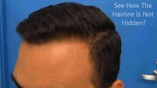 Hasson and Wong Hair Transplant BeforeAfter Results [upl. by Henarat]