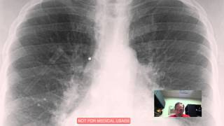 CXR Pulmonary Vascular Congestion Discussed by Radiologistmp4 [upl. by Maya]