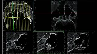 SPHENOID SINUS CASE REPORT [upl. by Baynebridge]