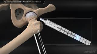 Hip Fracture Repair with Cannulated Screws [upl. by Lepp240]