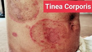 Understanding and Treating Tinea Corporis Expert Guide [upl. by Egwin]