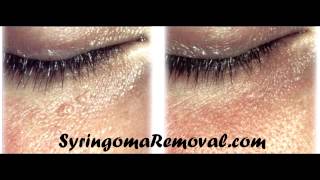 Syringoma removal cryotherapy [upl. by Estrin394]