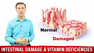 Intestinal Obstruction amp Vitamin Deficiencies – Dr Berg [upl. by Yajnas]