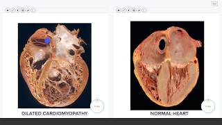 LG14 Cardiomyopathy Slide Review Video 9 min [upl. by Line801]