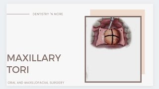 MAXILLARY TORI  MANDIBULAR TORI  PRE PROSTHETIC SURGERY [upl. by Aioj]