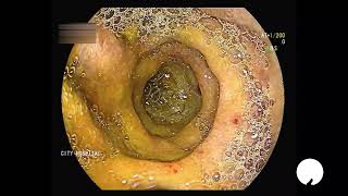 Duodenitis क्या होता है और कैसा दिखता   Dr Vivek Mishra MD DM  duodenitis endoscopy [upl. by Ahsat]