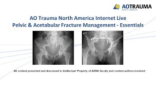 Radiology and Classification of Acetabular Fractures Dr Stephen Sims [upl. by Irrej]