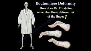 Boutonniere Deformity  Everything You Need To Know  Dr Nabil Ebraheim [upl. by Aeslek133]