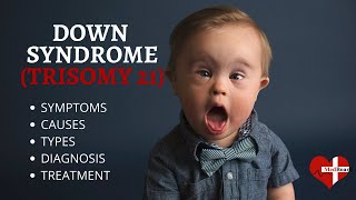 What is Down Syndrome Trisomy 21 Down syndrome Trisomy 21 Made Easy [upl. by Herates]