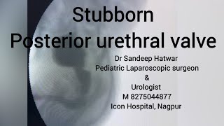 Posterior urethral valve fulguration [upl. by Feune]