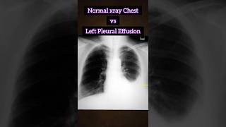 Normal xray vs Pleural Effusion 🩻 🫁 medical xray disease radiology infection shorts [upl. by Jonas]