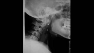 ArnoldChiari Malformation [upl. by Ainel]