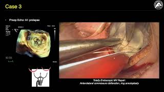 Commissural MR in the Minimally Invasive Cardiac Surgery Era A Piece of Cake [upl. by Neve]