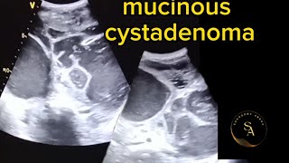 Ultrasound Imaging mucinous Cystadenoma [upl. by Cassiani672]