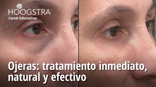 Ojeras tratamiento inmediato natural y efectivo  24130 [upl. by Rae988]