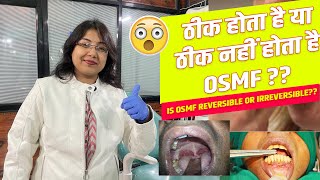 ठीक होता है या ठीक नहीं होता है OSMF  Is OSMF reversible or irreversible [upl. by Belter365]