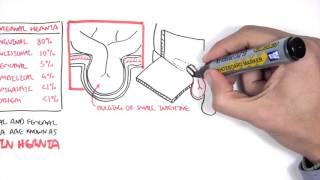 Introduction to Direct and Indirect Inguinal Hernia [upl. by Dorraj636]